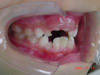 071117　teeth side_copy.jpg