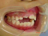 090806　teeth side　B_copy.jpg