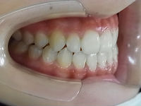 101225　teeth side_copy.jpg