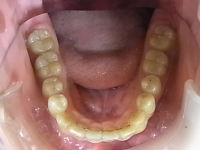 110617　lower teeth_copy.jpg