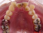 s-051012 upper teethcut.jpg