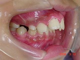 s-060313　teeth side.jpg