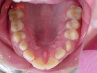 s-060829　upper teeth V字.jpg