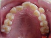 s-070216　upper teeth cut.jpg