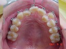 s-070512　upper teeth.jpg
