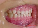 s-070518　teeth side.jpg