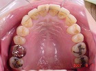 s-070605upper teethcut.jpg