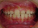 s-070811　whole teeth cut.jpg