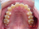 s-071012　upper teeth.jpg