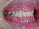 s-071204　teeth side.jpg