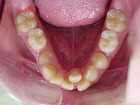 s-080125　lower teeth.jpg