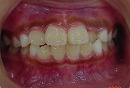 s-080403　whole teeth cut.jpg