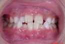 s-080617　whole teeth cut.jpg