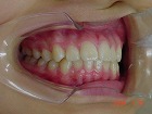 s-090131　teeth side.jpg