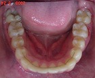 s-090324　lower teeth cut.jpg