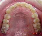 s-090324　upper teeth cut.jpg