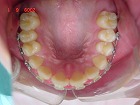 s-090601upper teeth　V字.jpg