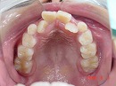 s-090601upper teeth.jpg