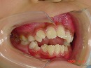 s-090611　teeth side.jpg