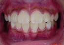 s-091119　whole teeth cut.jpg