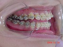 s-091218　teeth side.jpg