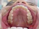 s-100209　upper teeth.jpg