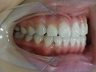 s-100727　teeth side.jpg