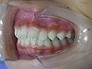 s-101015　teeth side2.jpg