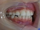 s-101018　teeth side.jpg