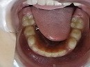 s-101111　lower teeth.jpg