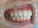 s-101206　teeth side.jpg