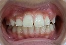 s-110122　whole teeth cut.jpg