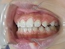 s-110129　teeth side2.jpg