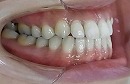 s-110208　teeth side cut.jpg