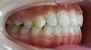 s-110528　teeth side cut.jpg