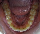 s-s-100615　lower teeth cut.jpg