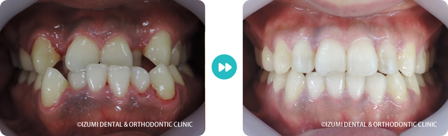 正面:外科(骨切り)処置を回避できたインビザライン症例