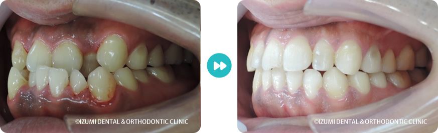 左側:外科(骨切り)処置を回避できたインビザライン症例