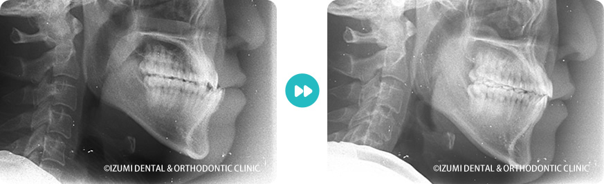 レントゲン:外科(骨切り)処置を回避できたインビザライン症例