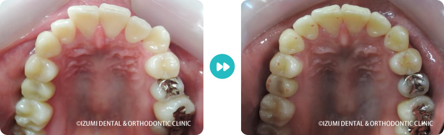上顎:外科(骨切り)処置を回避できたインビザライン症例