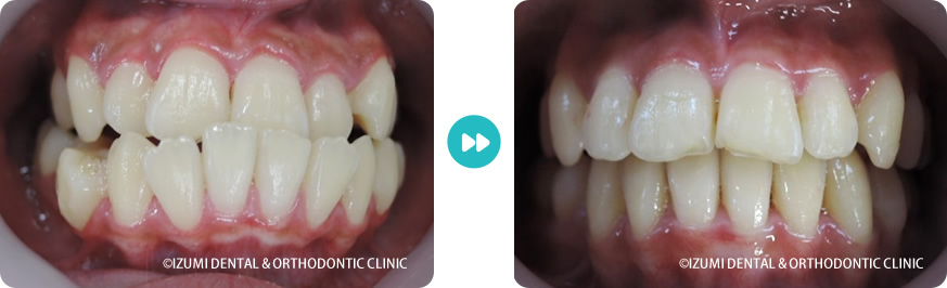 正面:外科(骨切り)処置を回避できたインビザライン症例