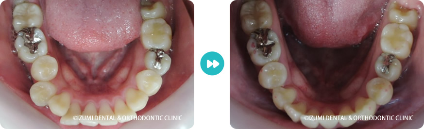 下顎:外科(骨切り)処置を回避できたインビザライン症例
