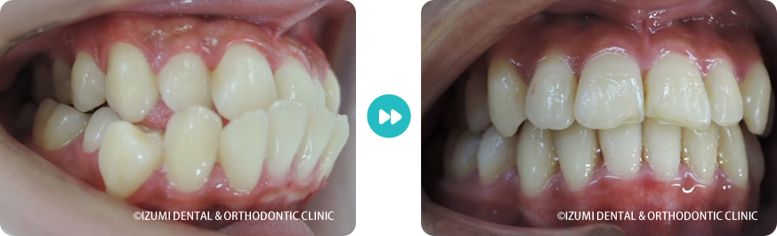 右側:外科(骨切り)処置を回避できたインビザライン症例