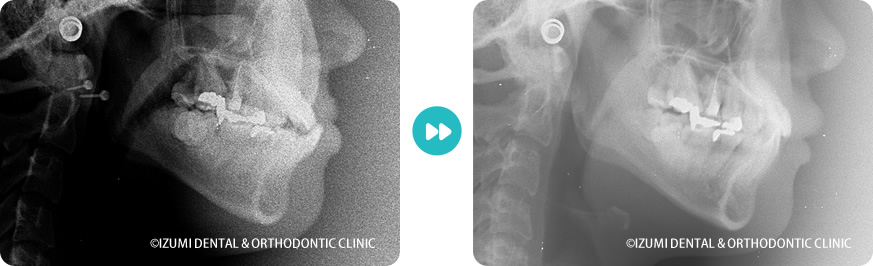 レントゲン:外科(骨切り)処置を回避できたインビザライン症例