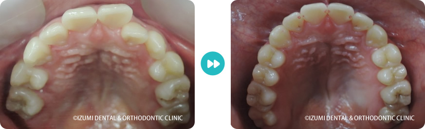 上顎：外科(骨切り)処置を回避できたインビザライン症例