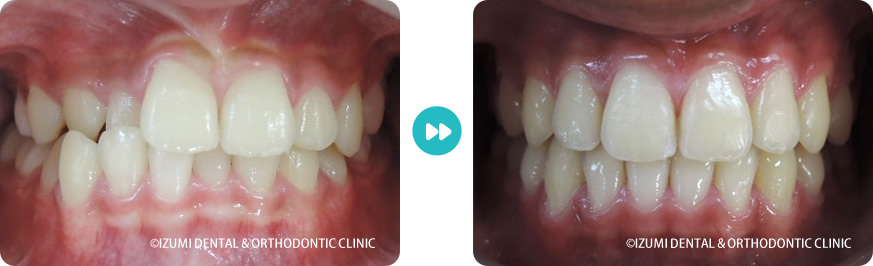 正面：外科(骨切り)処置を回避できたインビザライン症例