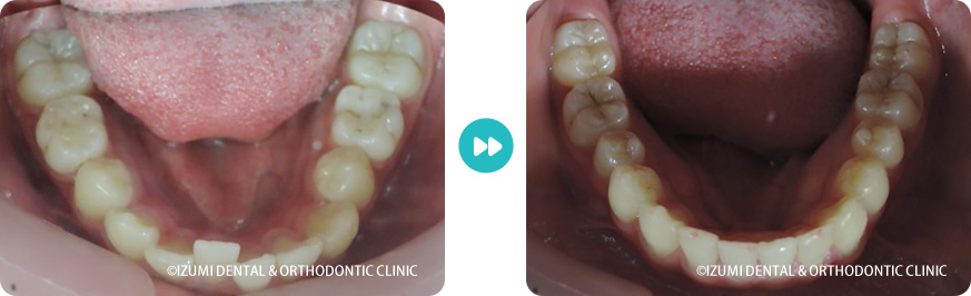 下顎：外科(骨切り)処置を回避できたインビザライン症例