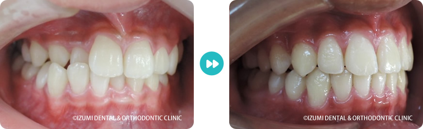 右側：外科(骨切り)処置を回避できたインビザライン症例