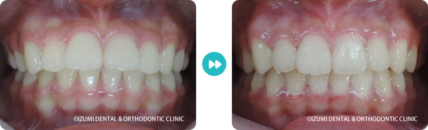 正面:インビザライン症例