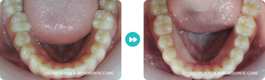 下顎:インビザライン症例